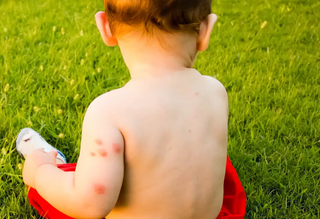 bed bug bite on babies